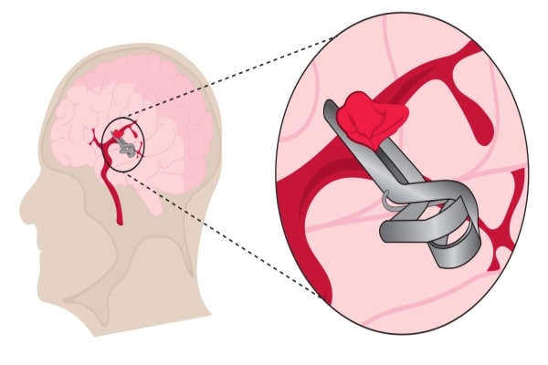 Aneurysm Clipping