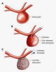 Best aneurysm clipping treatment in sarjapur road