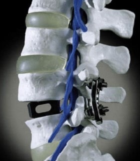 Best lumbar spinal treatment in sarjapur road